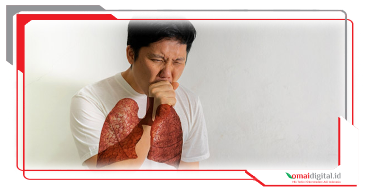 Kemenkes Lakukan Perbaikan Sistem Deteksi dan Pelaporan Kasus TBC Kemenkes Lakukan Perbaikan Sistem Deteksi dan Pelaporan Kasus TBC